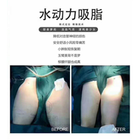 吸脂后会出现凹凸不平的原因是什么