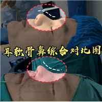 哪家医院做鼻综合比较好