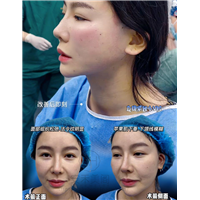 筋膜悬吊提升术是什么