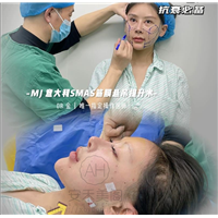 筋膜悬吊面部提升术多久有效果