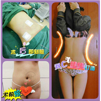 抽脂后需要穿多长时间的塑身裤
