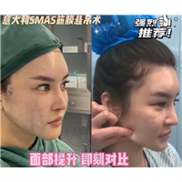 什么是筋膜悬吊面部提升术
