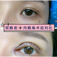 微创双眼皮整形手术的优势有哪些