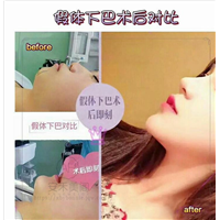 影响垫下巴整形价格的因素有哪些