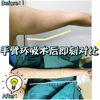 腰腹部吸脂价格是多少?一般多少钱