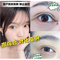割双眼皮效果好吗_割双眼皮效果对比