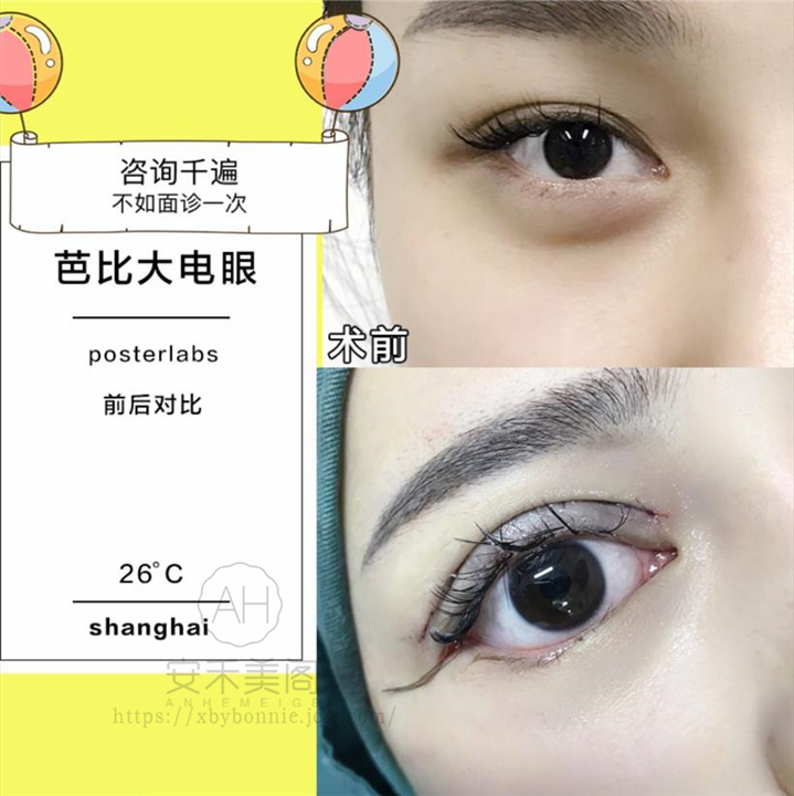 为什么现在人们想做双眼皮整形