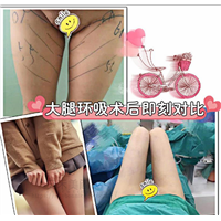 上海吸脂瘦身哪个好