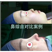 上海鼻翼基底凹陷修复整形