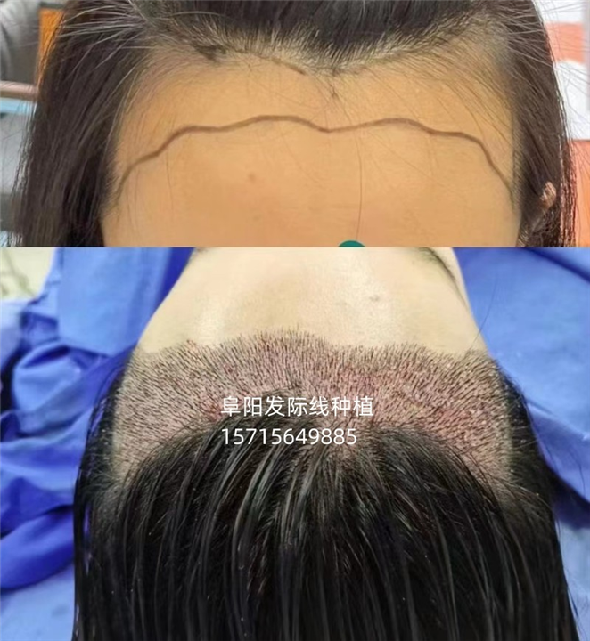 合肥发际线种植哪家好