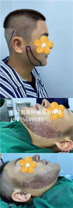 合肥头发植发鬓角种植