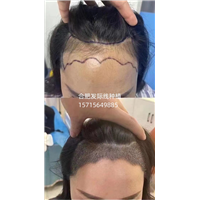 淮南发际线种植