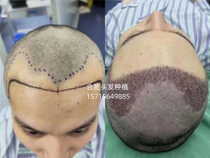 合肥头发种植