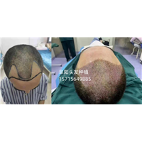 阜阳头发种植哪家好