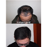六安头发种植哪家好