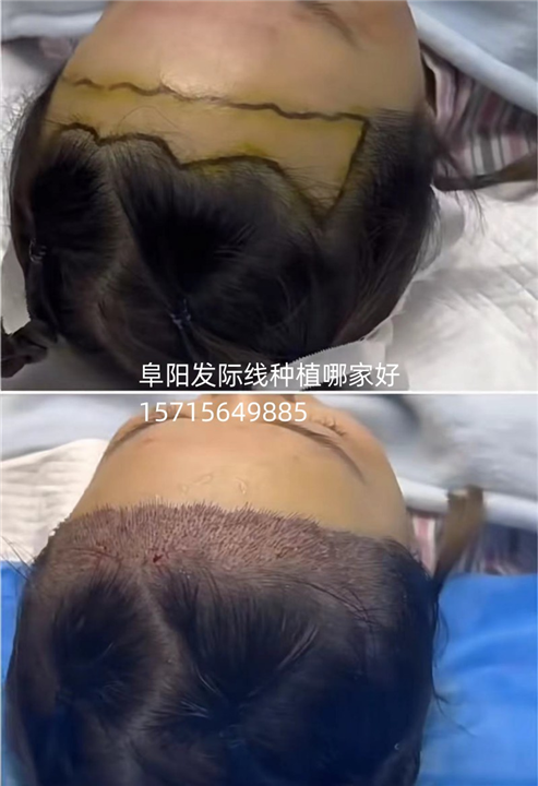 阜阳发际线种植
