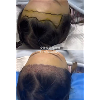阜阳发际线种植