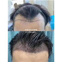 淮南发际线种植
