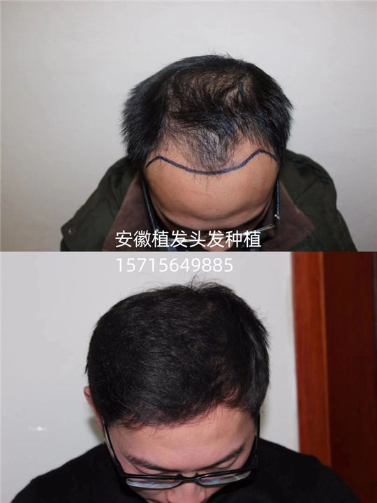 六安头发种植哪家好