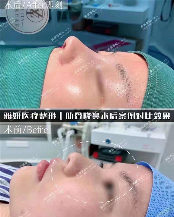 婕熹卡整形｜广州网红整形