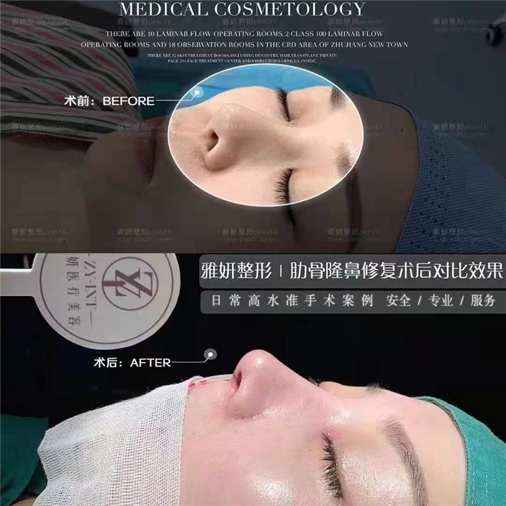 婕熹卡整形｜广州网红整形