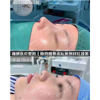 婕熹卡整形｜广州网红整形