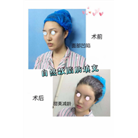 北京脂肪填充 