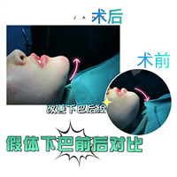 北京做假体下巴手术哪家好 