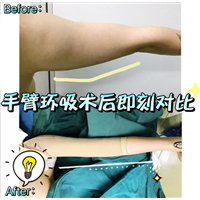 北京瘦身吸脂手术 