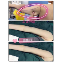 北京吸脂瘦身手术 