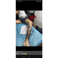 厦门思明佛山遮盖疤痕剖腹产纹身遮盖疤痕