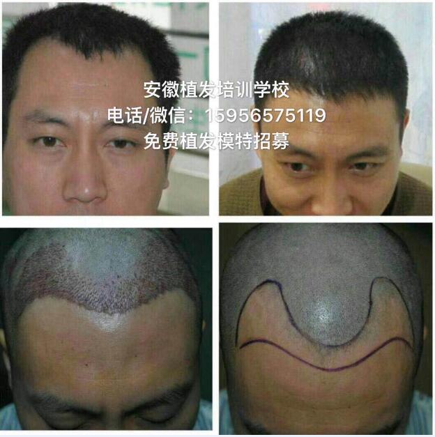 安徽植发培训