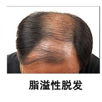 安徽植发哪里好