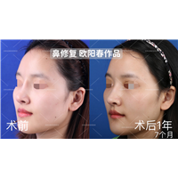 欧阳教授高难度鼻修复