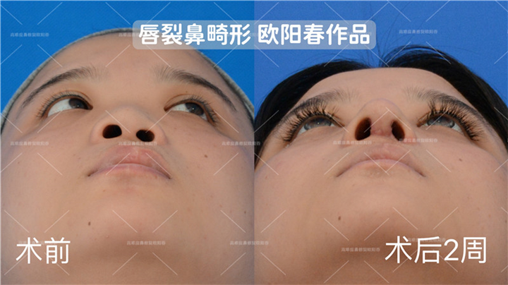 欧阳春教授唇裂鼻修复