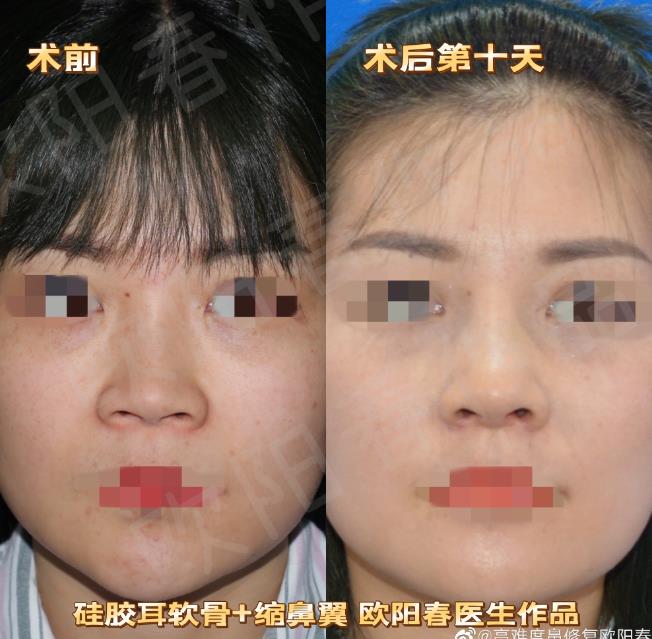 广州鼻整形