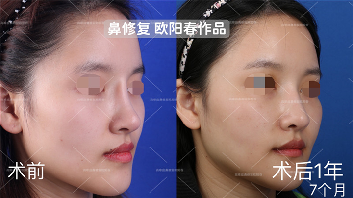 欧阳教授高难度鼻修复