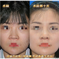 欧阳春鼻整形口碑如何