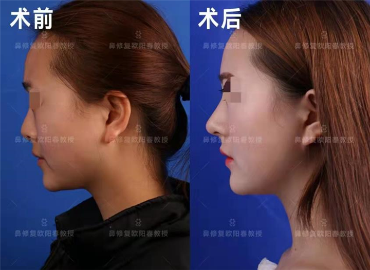 欧阳春鼻修复多少钱