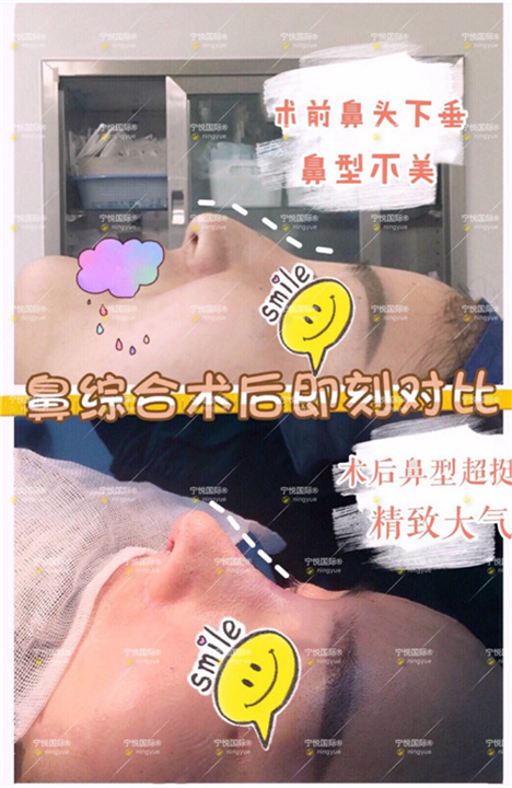 欧阳春鼻修复
