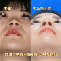 欧阳教授美容性初鼻案例