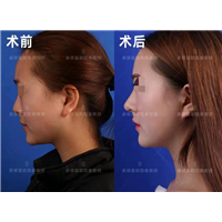 欧阳春鼻修复多少钱