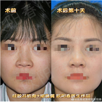 欧阳教授美容性初鼻案例