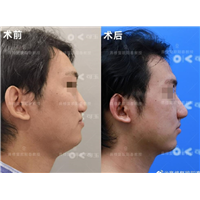 广州鼻修复专家