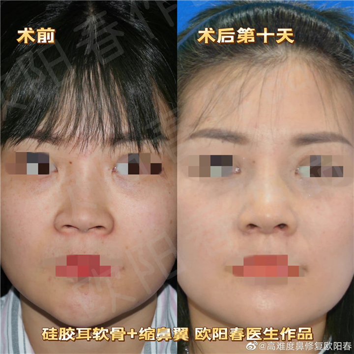 欧阳教授美容性初鼻案例