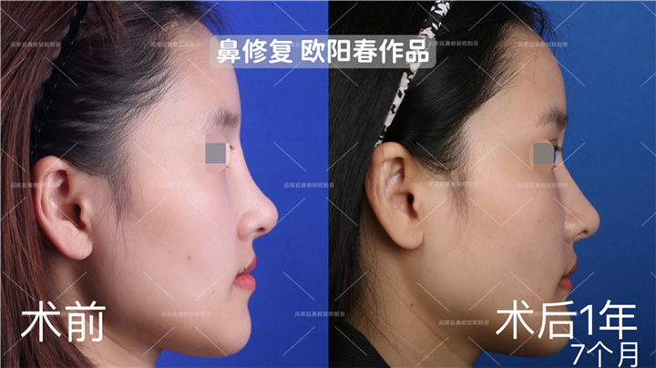 欧阳教授高难度鼻修复