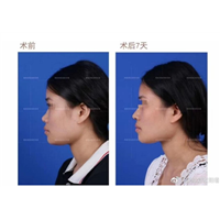 广州鼻整形专家