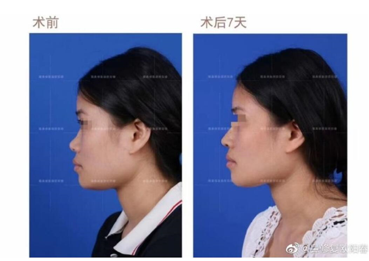 广州鼻整形专家
