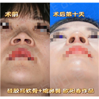 广州假体隆鼻做的好的医院
