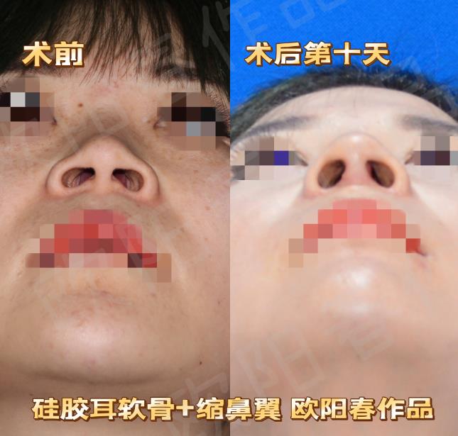 广州假体隆鼻做的好的医院